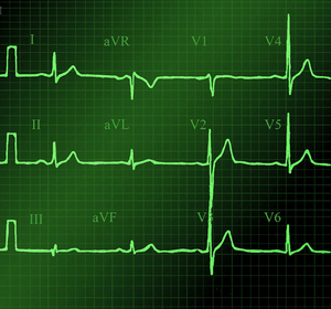 eletrocardiograma